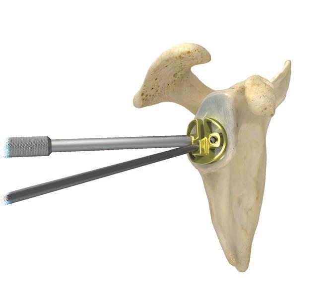 14 Comprehensive Reverse Shoulder System Surgical Technique Figure 25 Glenoid There are two baseplate options (Mini and Standard) available, each with