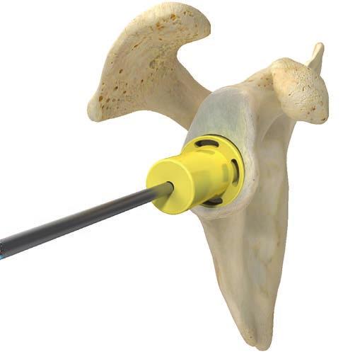 This can be done with two different methods. Method 1: Using the cannulated trial glenoid baseplate, position the glenoid baseplate provisional over the Steinmann pin and into the prepared glenoid.