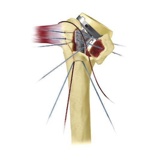 33 Comprehensive Reverse Shoulder System Surgical Technique Figure 59 Figure 60 Figure 61 Fracture: Tuberosity Reconstruction (cont.