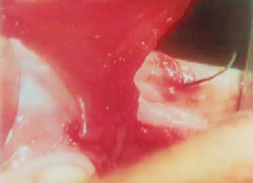 A photograph showing oro-nasal fistula at the