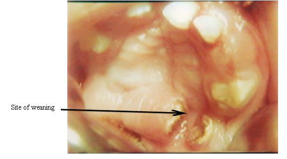 A photograph showing a completely healed pedicle with good vascularity sealing the alveolar margin defect which needs no weaning.