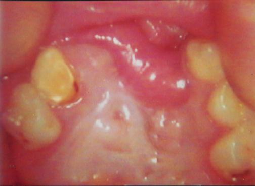 Sources of additional tissue are usually in the form of pedicled flaps from elsewhere in the mouth, according to the site of fistula e.g., buccal mucosa 8 or tongue flaps.