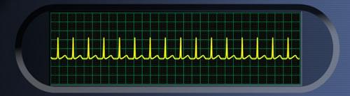 AV Nodal Reentrant Tachycardia Origin: AV nodal region Mechanism: Reentry Tachycardia Rate: 100 280 BPM (most around 170 bpm) ECG: QRS normal, P-wave not seen during tachycardia