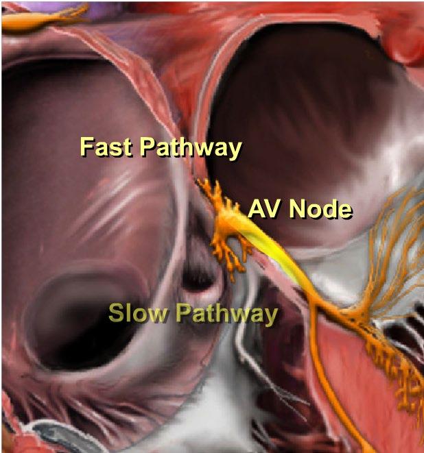 AVNRT: Dual AV Node Physiology AVNRT Normal Sinus
