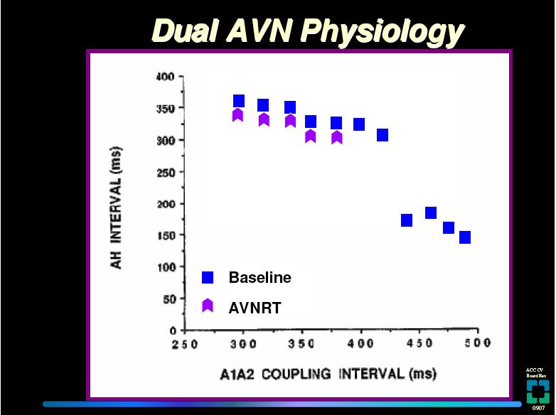 Slow Pathway 50 ms AH interval with atrial