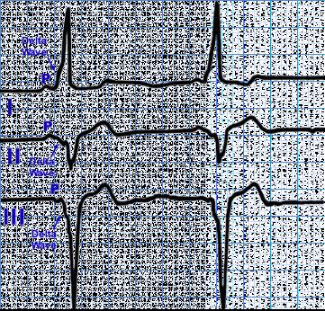 Wolff-Parkinson-White Pattern: Ventricular Preexcitation ECG