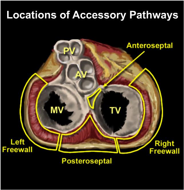 AV Reentry Tachycardia (AVRT): Accessory pathways Atrioventricular bypass tracts, or accessory pathways, can be found anywhere along the muscular portion of the posterior and lateral aspects of the