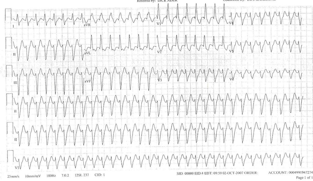 Supraventricular Tachycardia Not all SVTs have a narrow QRS