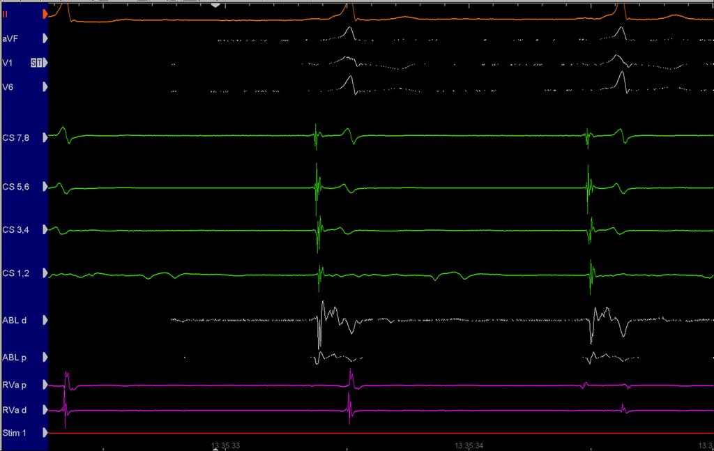WPW Catheter Ablation Left Lateral