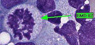 Cell Identification Mitotic figure 212 99.5 Educational Erythrocyte precursor, abnormal BMD-02 The arrowed cell is a mitotic figure. It was correctly identified by 99.5% of the participants.