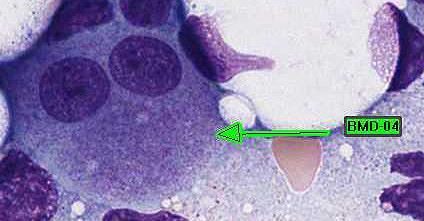 Megakaryocyte or precursor, 173 81.2 Educational abnormal Megakaryocyte or precursor, normal 30 14.1 Educational Osteoclast 5 2.3 Educational Plasma cell, abnormal (malignant, 2 0.