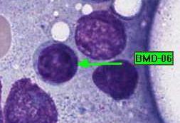 Lymphocyte, normal 198 92.9 Educational Erythrocyte precursor, normal 12 5.