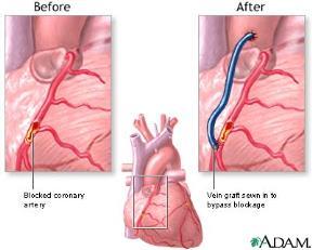 The AVERT study: Patients were randomized to receive Lipitor or angioplasty The patients who did not receive surgery experienced fewer heart attacks, less chest pain, and made fewer visits to the