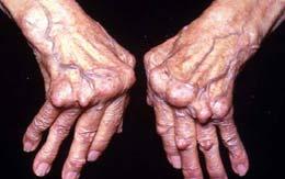 arthropathy Hands & feet > 80% cases