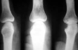 Xray changes in rheumatoid arthritis ARA criteria for diagnosis of rheumatoid arthritis 1. Morning stiffness periarticular osteoporosis 2. Arthritis of 3 or more joint areas 3.