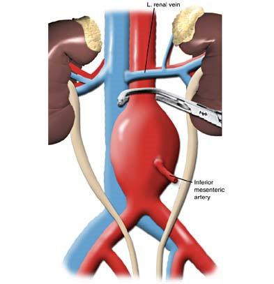 Abdominal Aortic Aneurysm Repair Open AAA High Risk Surgery High Morbidity and Mortality 30 day Morbidity 12-26% 30