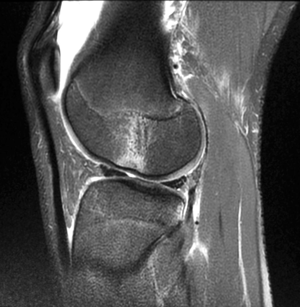 LARGE (300+) SAMPLE high incidence of posterior tibial fractures coinciding with ACL