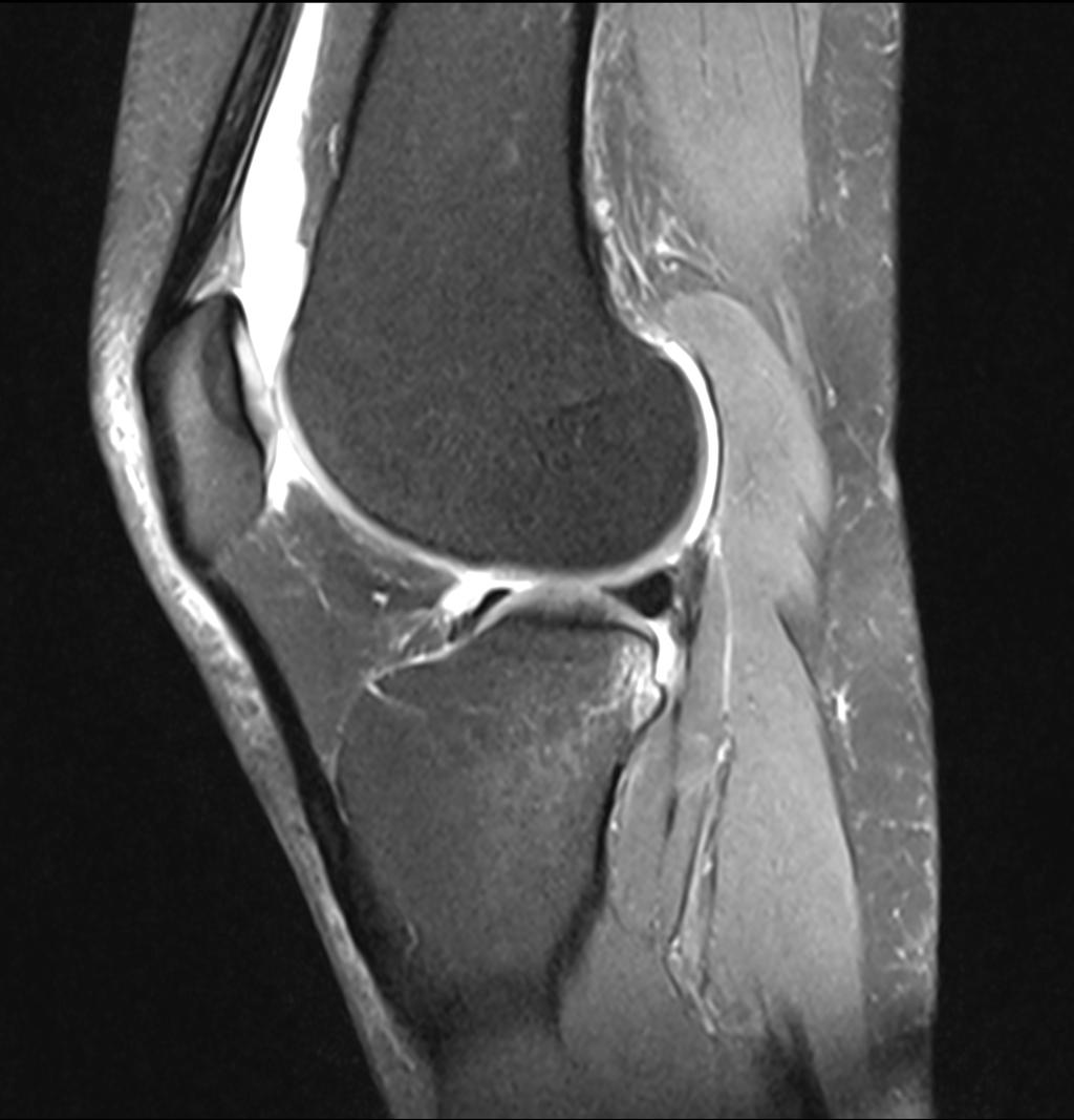 the meniscus is still fully supported GRADES I & II do not require surgical