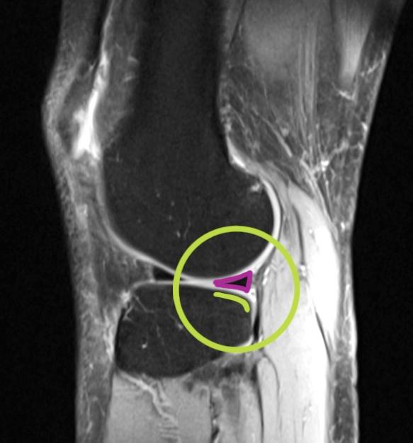 OBJECTIVE BACKGROUND: Identification of disruptions in the congruency of the lateral meniscus (LM)' setting on the tibial plateau in case of patients with the anterior cruciate ligament (ACL) injury