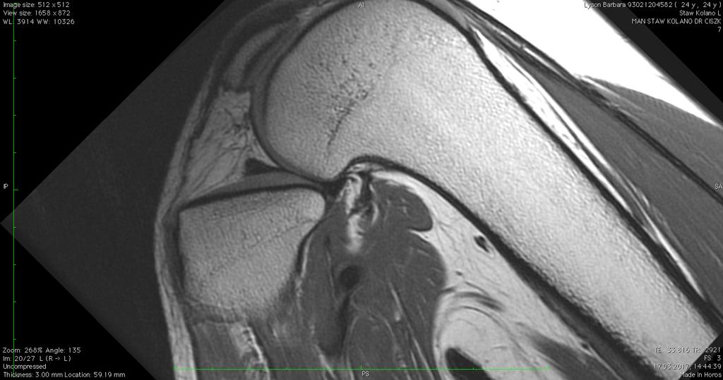 setting of the posterior part of the lateral meniscus.