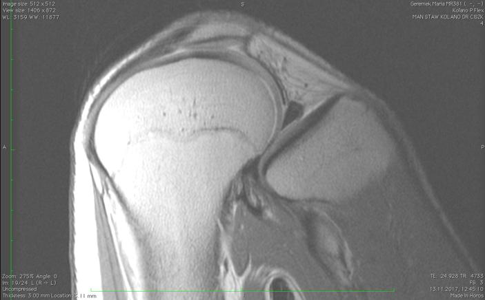MRI. PD sagittal plane. Healthy knee in flexion.