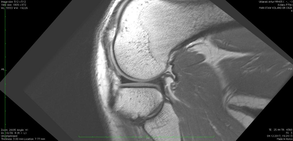 MRI. PD sagittal plane. Healthy knee in full flexion.