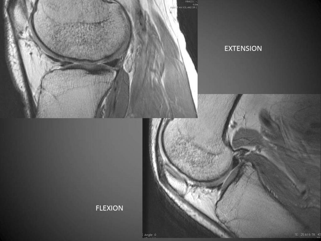 RESULTS EXTENSION The control group s MRIs confirmed the lateral meniscus slope onto its dedicated surface on the posterior tibial plateau.
