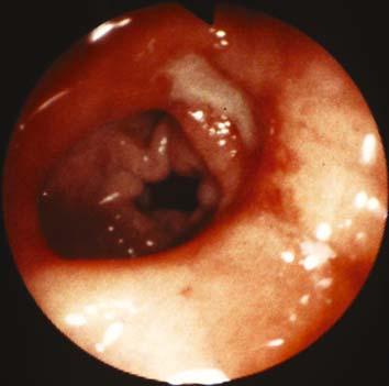 Biopsy proved this to e enign ulcer c Fig. 2.3,.