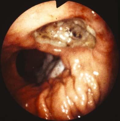 Ischemic gstric ulcer (itrogenic).