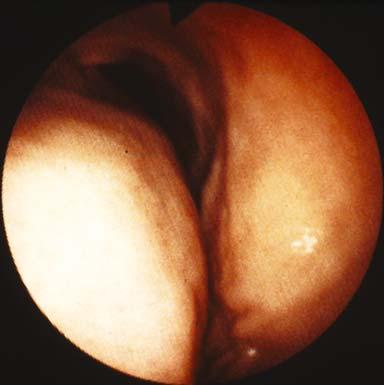 Note the deep ulcertion t the cudl side of the tumour, commonly seen