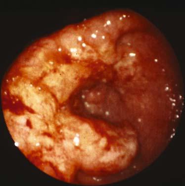 Endoscopic-ultrsound () confirms its fluid nture, comptile with enign cyst,
