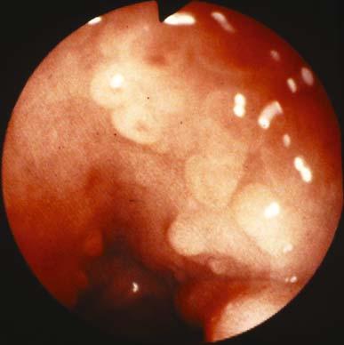 Endoscopy () shows the prolpsed folds Fig. 2.24 c.