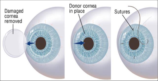 A full thickness circular portion is removed from the centre of your cornea. A similar circular portion is then taken from the centre of the donor cornea (this is the corneal graft).