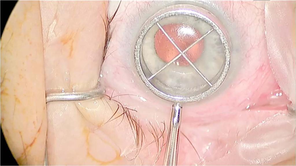 Surgical steps and techniques: DSEK Wound Descemetorrhexis Insertion Positioning Apposition Wound Closure