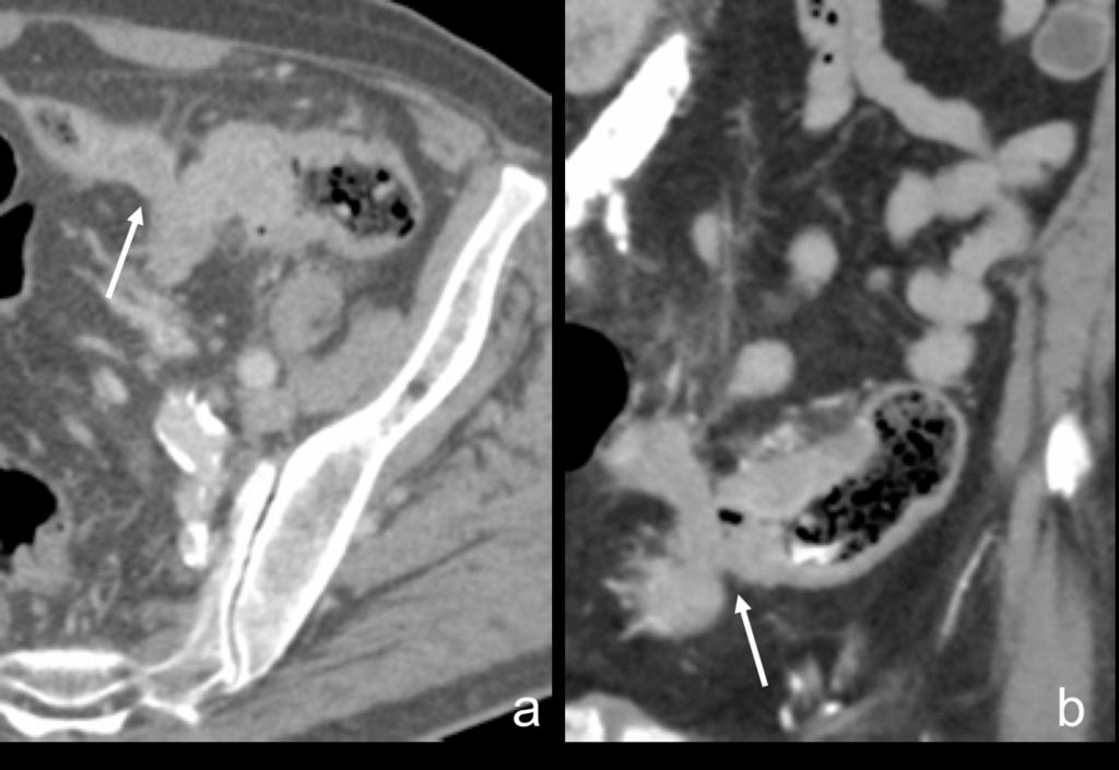 Fig. 6: Axial (a) and coronal (b) CT images after contrast administration (portal venous phase) showing a