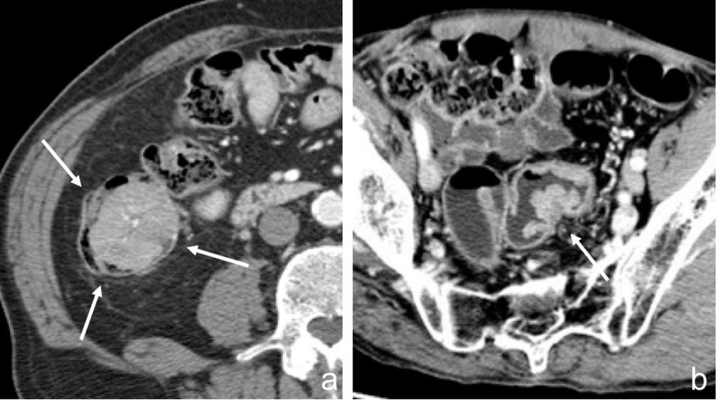 Fig. 3: Axial CT images after contrast administration (portal venous phase)