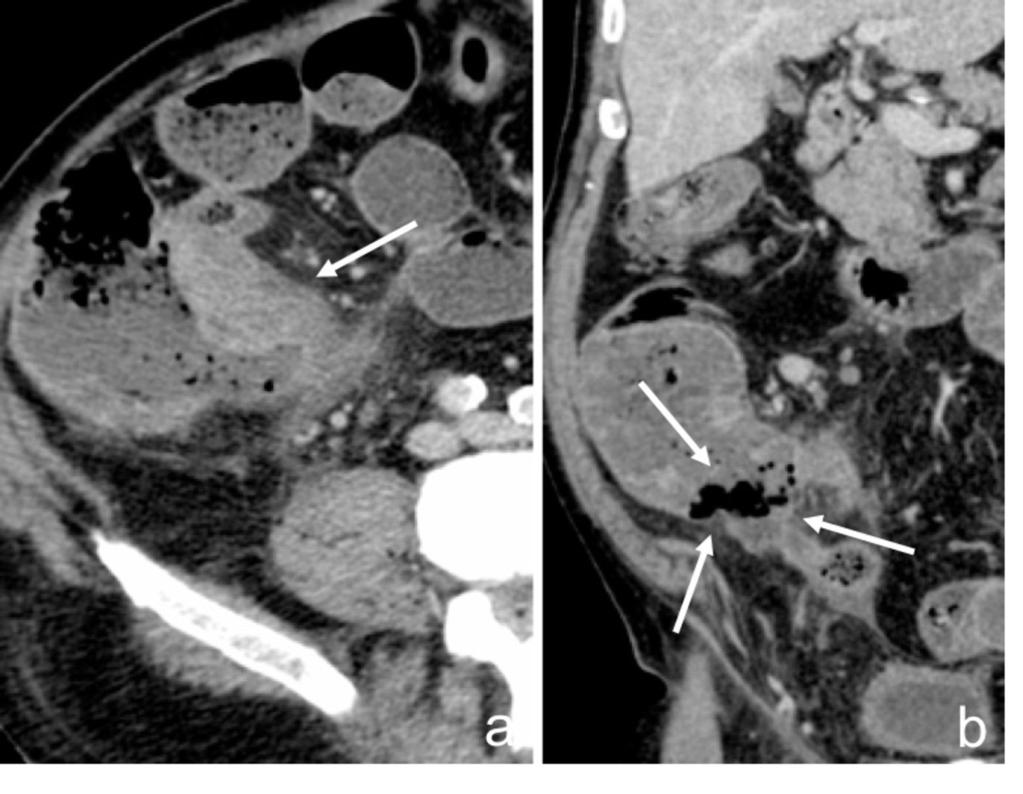 Fig. 4: Axial (a) and coronal (b) CT images after contrast administration (portal venous phase) showing a