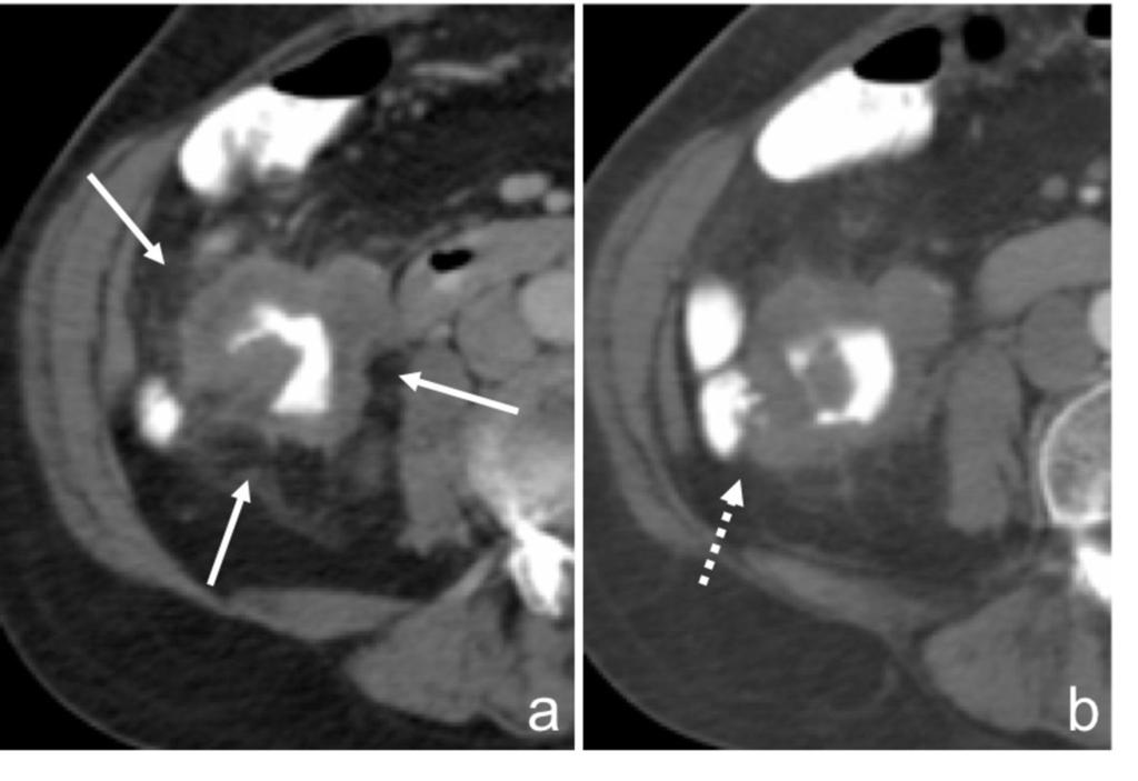 Fig. 5: Axial CT images after rectal and IV contrast administration (portal venous phase) showing a T4 tumor of the ascending colon with invasion