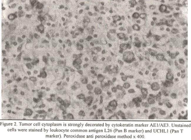 However, there were a number of tumour cells morphologically similar to lymphoid cells, which were reactive for both cytokeratin antibodies. Mucin stains PAS and alcian blue were equivocal.