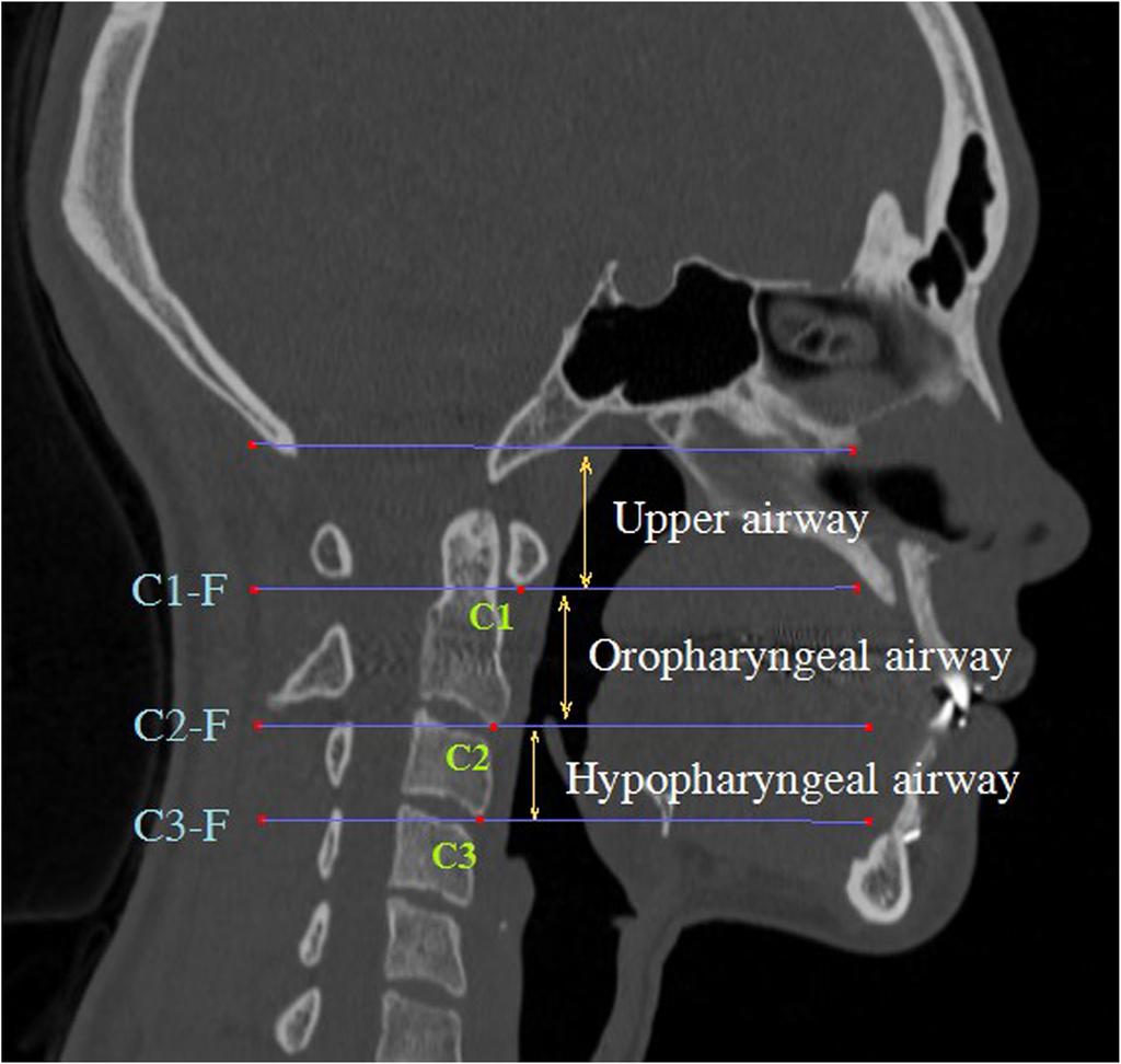 Oropharyngeal airway: The airway space between C1-F and C2-F. Hypopharyngeal airway: The airway space between C2-F and C3-F Fig. 3 a.