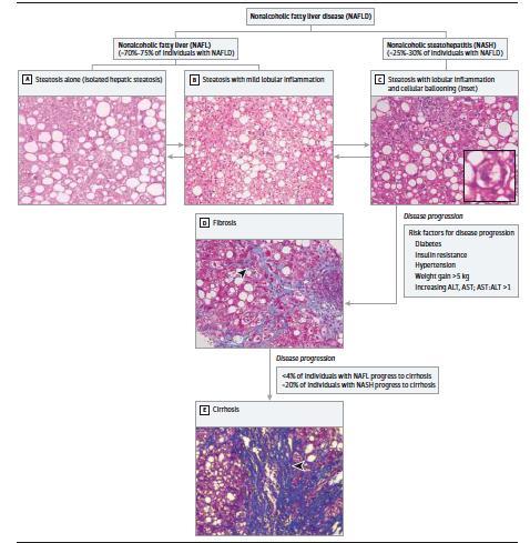 Paucity in features of NASH in liver histology of