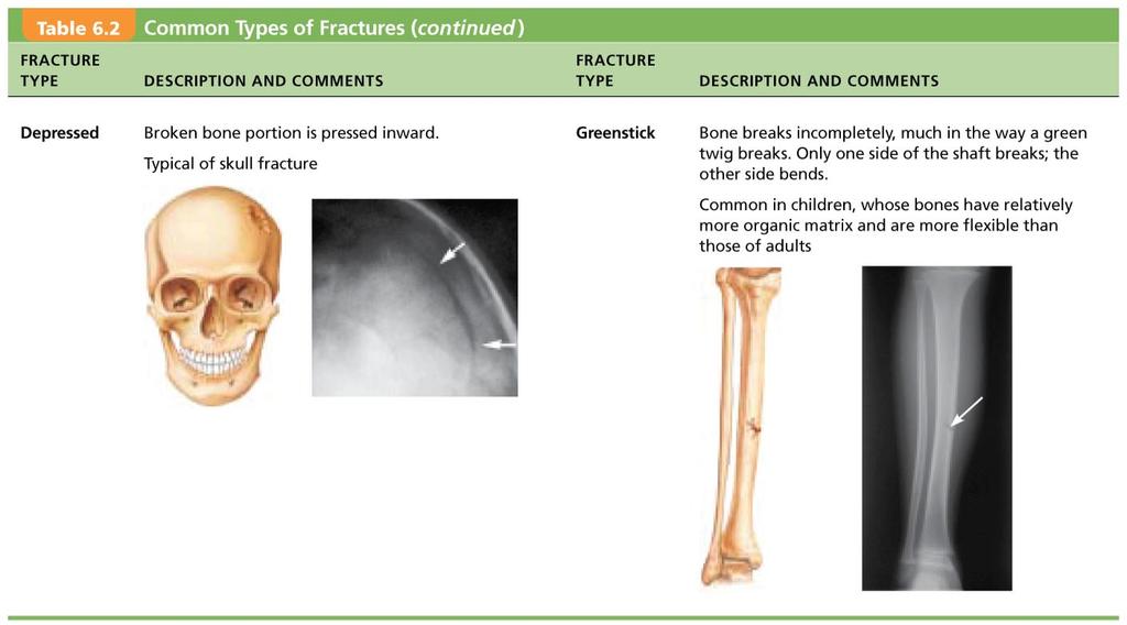 Fibrocartilage Callus forms: «New capillaries formed (granulation tissue) «Repair tissue