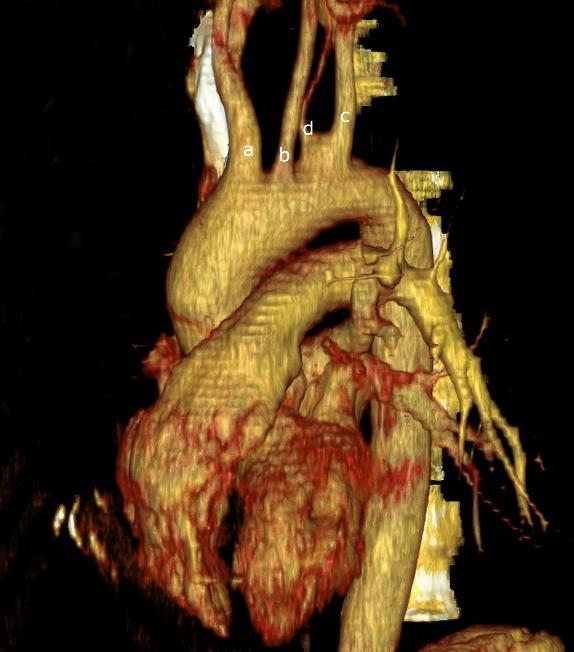 e. Type 5 f. Type 6 g. Type 7 Figure 1: Types of the aortic arch [a. Brachiocephalic trunk b. Left common carotid artery c. Left subclavian artery d. Vertebral artery a1. Right subclavian artery a2.