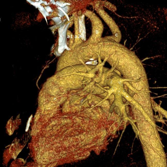 brachiocephalic trunk and left common carotid artery in the form of a single root and the second branch is the left subclavian artery. This type, determined as Type 2, is the most common (25.