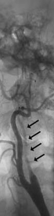 ICA near total occlusion Should we