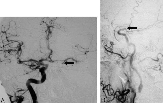 Radiological criteria for the diagnosis of ICA near total occlusion intracranial collaterals seen as cross-filling of contralateral vessels or