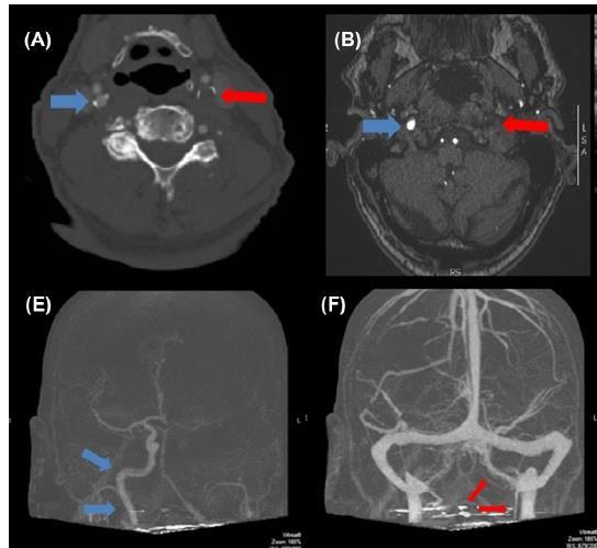Carotid Pseudo-Occlusion in Hyperacute Stroke Acute stroke patients with an apparent tandem occlusion on conventional single-phase CTA can have delayed antegrade