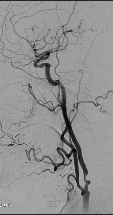 angiography in