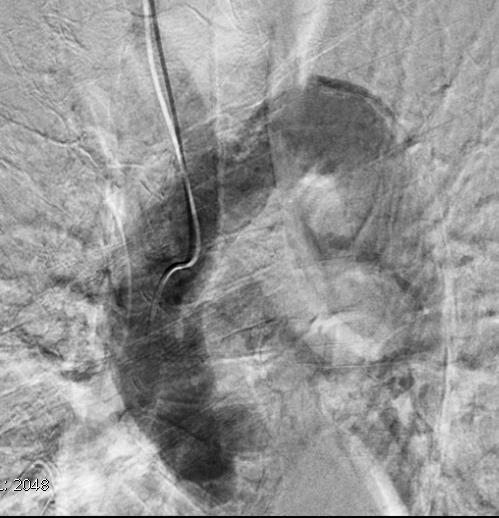 Aortography with 15 ml