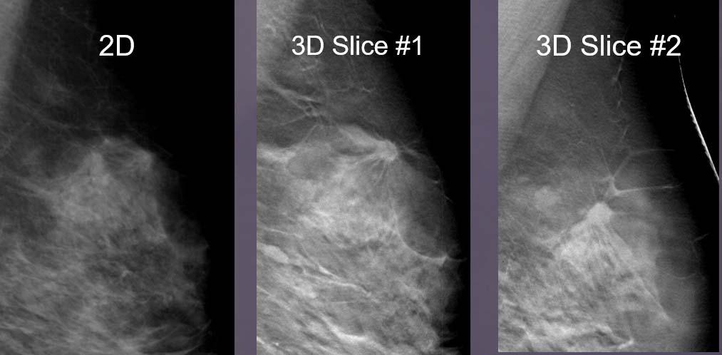 Supplemental Screening for Dense Breasts 3D Mammography